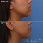 Buccal Fat Removal Before and After Photo by Dr. Foulad in Beverly Hills California