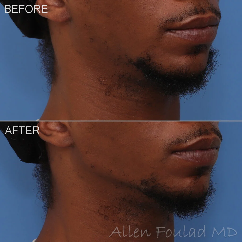 Filler Before and After Photo by Dr. Foulad in Beverly Hills California