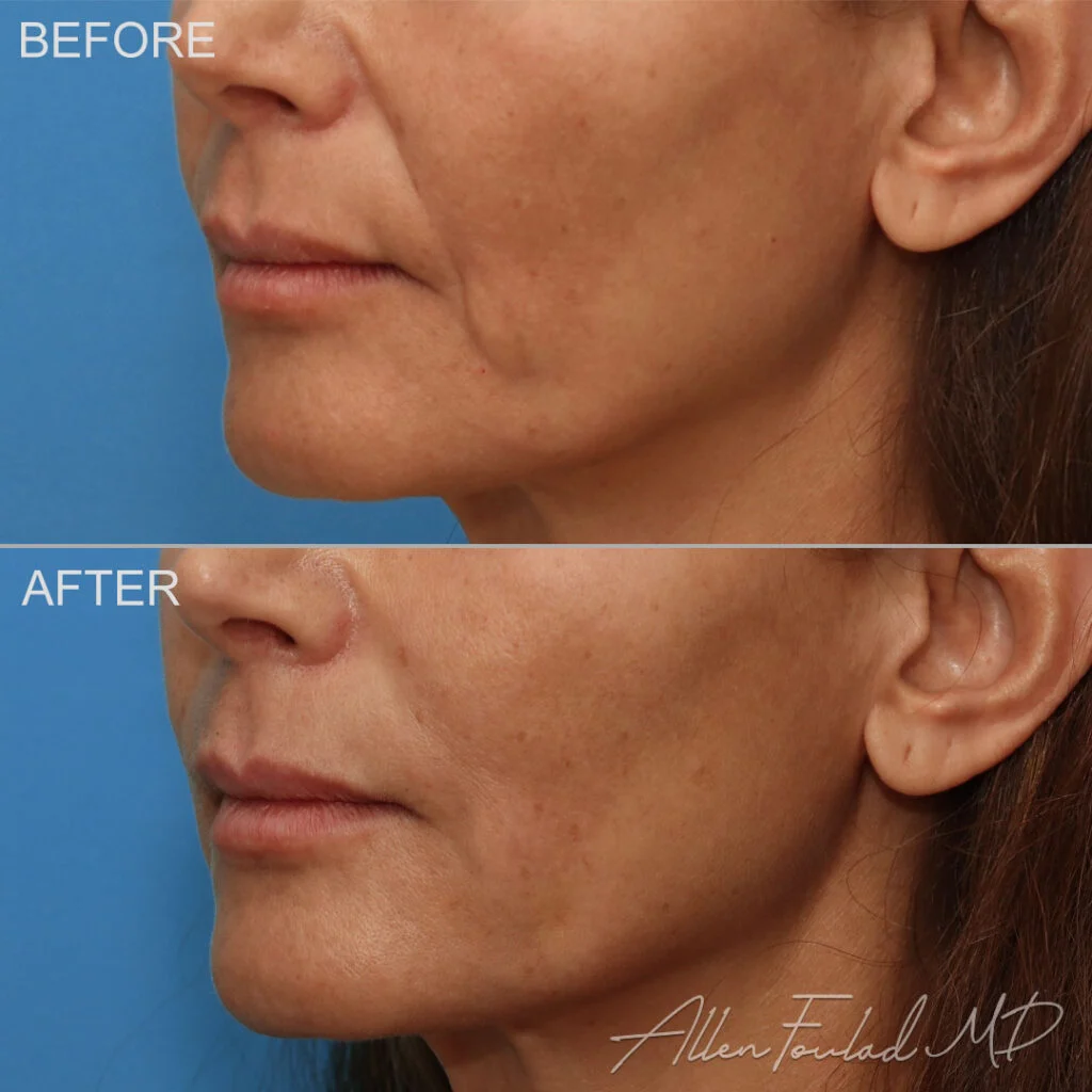 Filler Before and After Photo by Dr. Foulad in Beverly Hills California