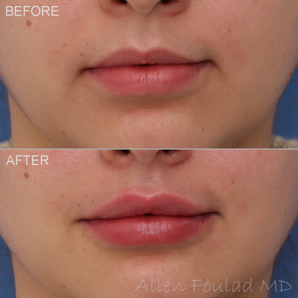 Filler Before and After Photo by Dr. Foulad in Beverly Hills California