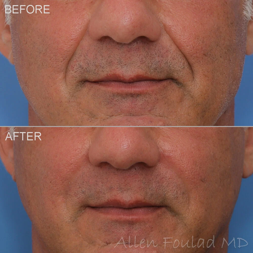 Filler Before and After Photo by Dr. Foulad in Beverly Hills California