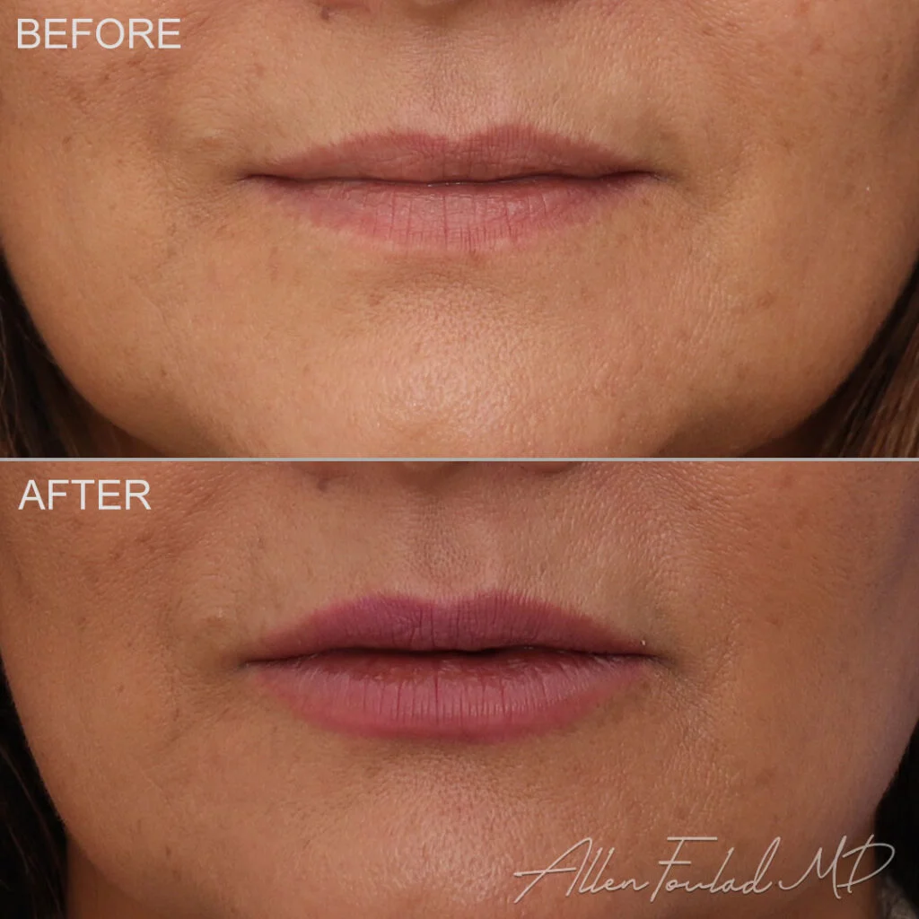 Filler Before and After Photo by Dr. Foulad in Beverly Hills California