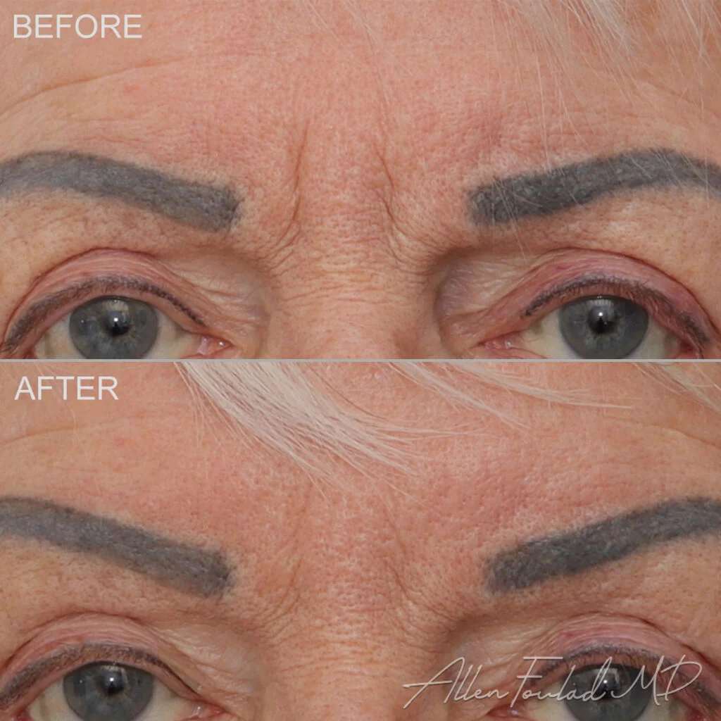 Neuromodulators Before and After Photo by Dr. Foulad in Beverly Hills California