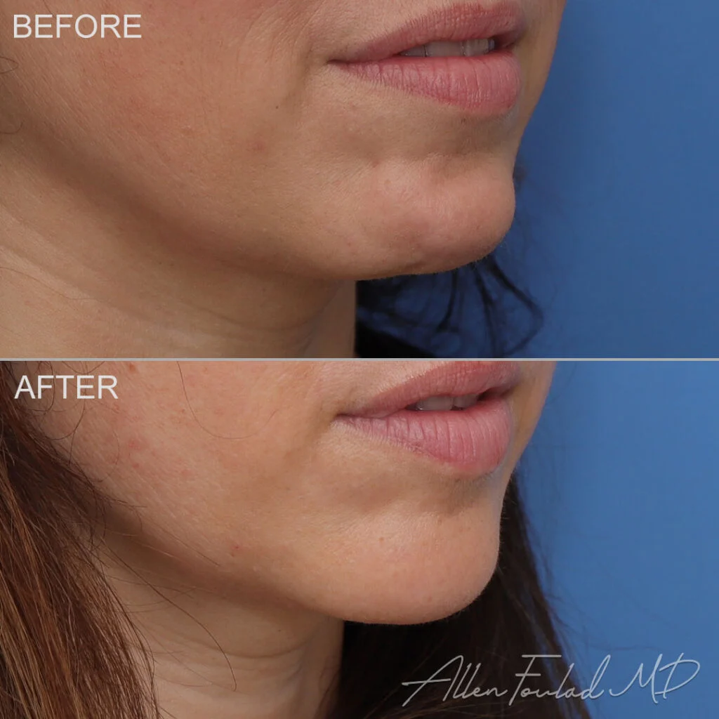 Neuromodulators Before and After Photo by Dr. Foulad in Beverly Hills California