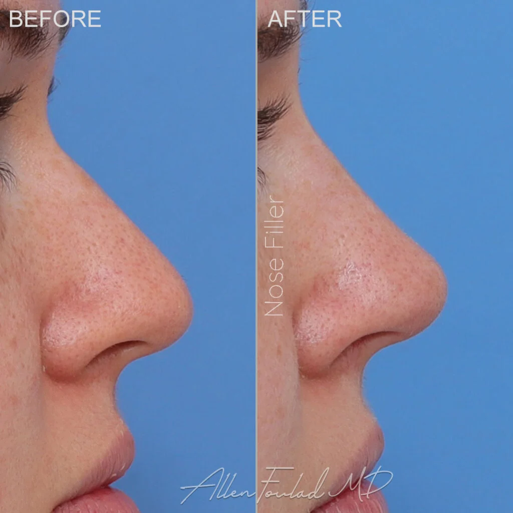 Filler Before and After Photo by Dr. Foulad in Beverly Hills California