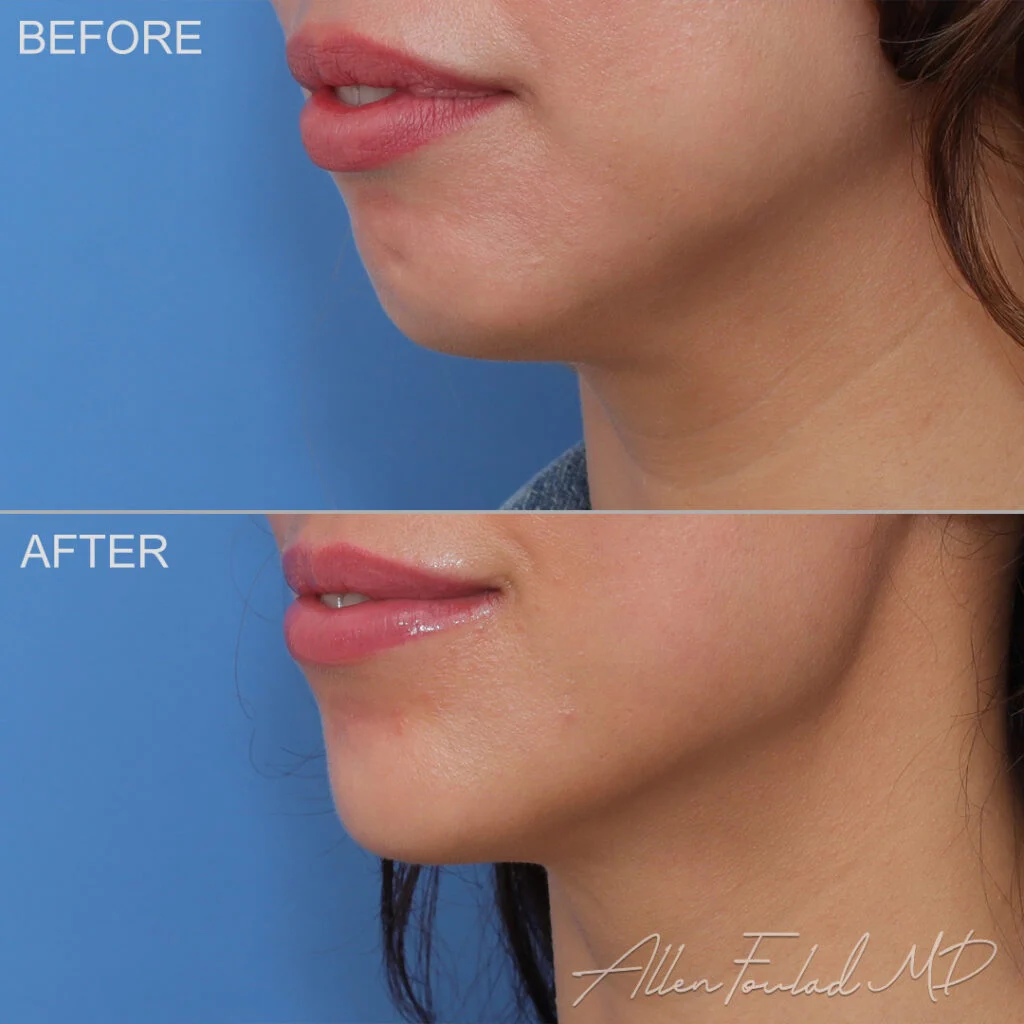 Filler Before and After Photo by Dr. Foulad in Beverly Hills California