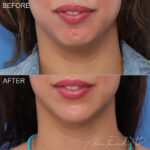 Filler Before and After Photo by Dr. Foulad in Beverly Hills California