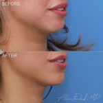 Filler Before and After Photo by Dr. Foulad in Beverly Hills California