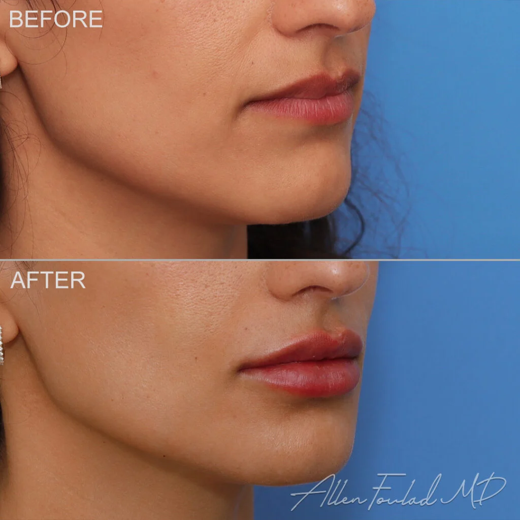 Filler Before and After Photo by Dr. Foulad in Beverly Hills California