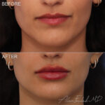 Filler Before and After Photo by Dr. Foulad in Beverly Hills California