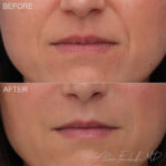 Filler Before and After Photo by Dr. Foulad in Beverly Hills California