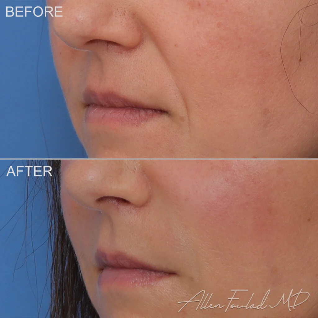 Filler Before and After Photo by Dr. Foulad in Beverly Hills California