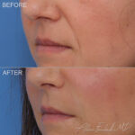 Filler Before and After Photo by Dr. Foulad in Beverly Hills California