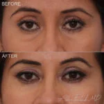 Filler Before and After Photo by Dr. Foulad in Beverly Hills California