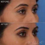 Filler Before and After Photo by Dr. Foulad in Beverly Hills California