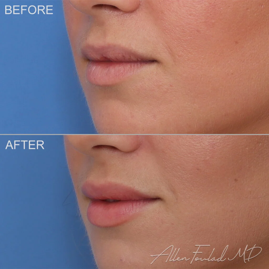 Filler Before and After Photo by Dr. Foulad in Beverly Hills California