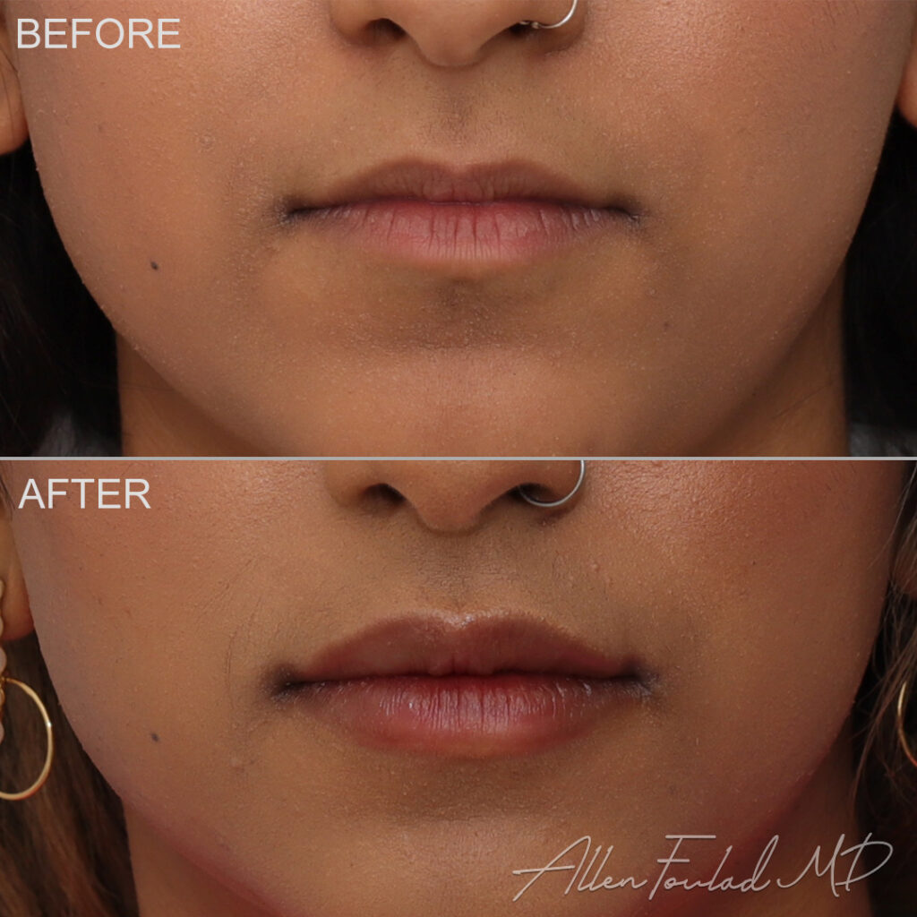 Filler Before and After Photo by Dr. Foulad in Beverly Hills California