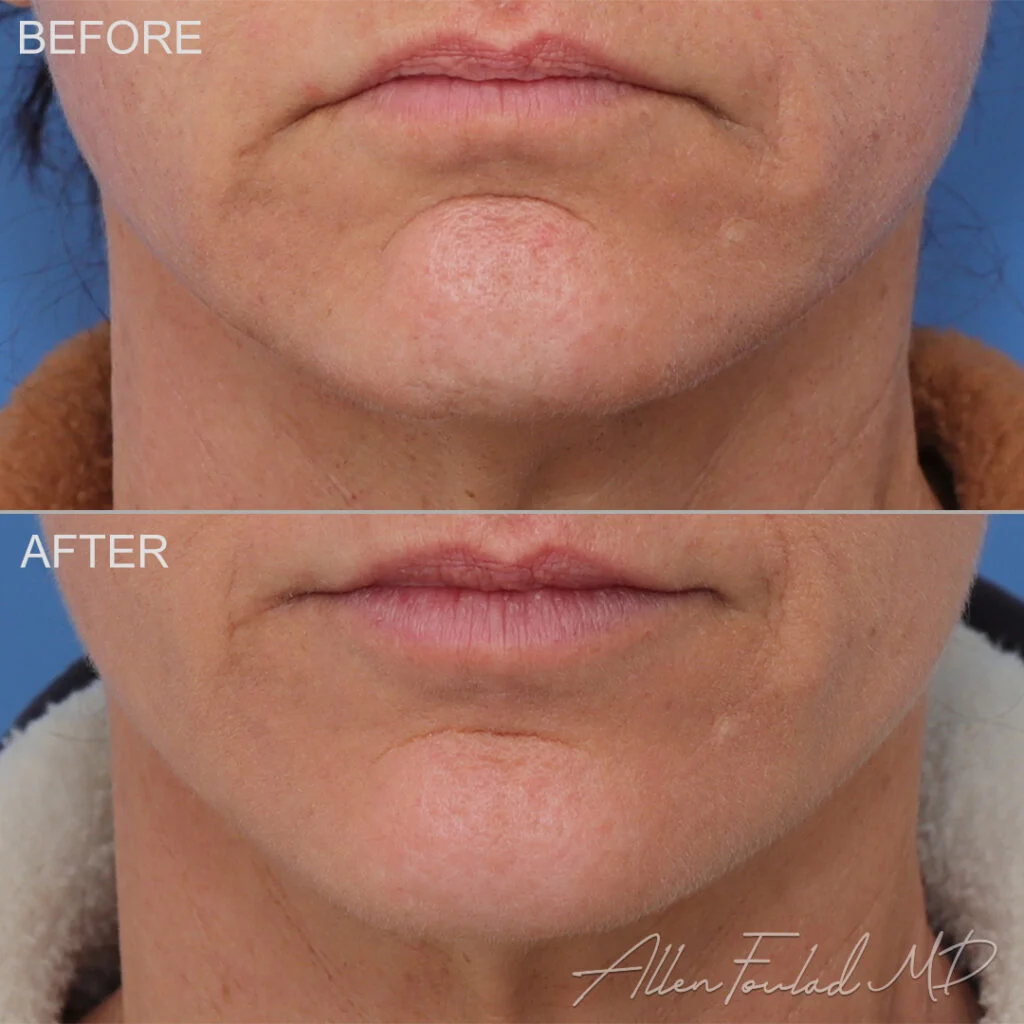 Botox Before and After Photo by Dr. Foulad in Beverly Hills California