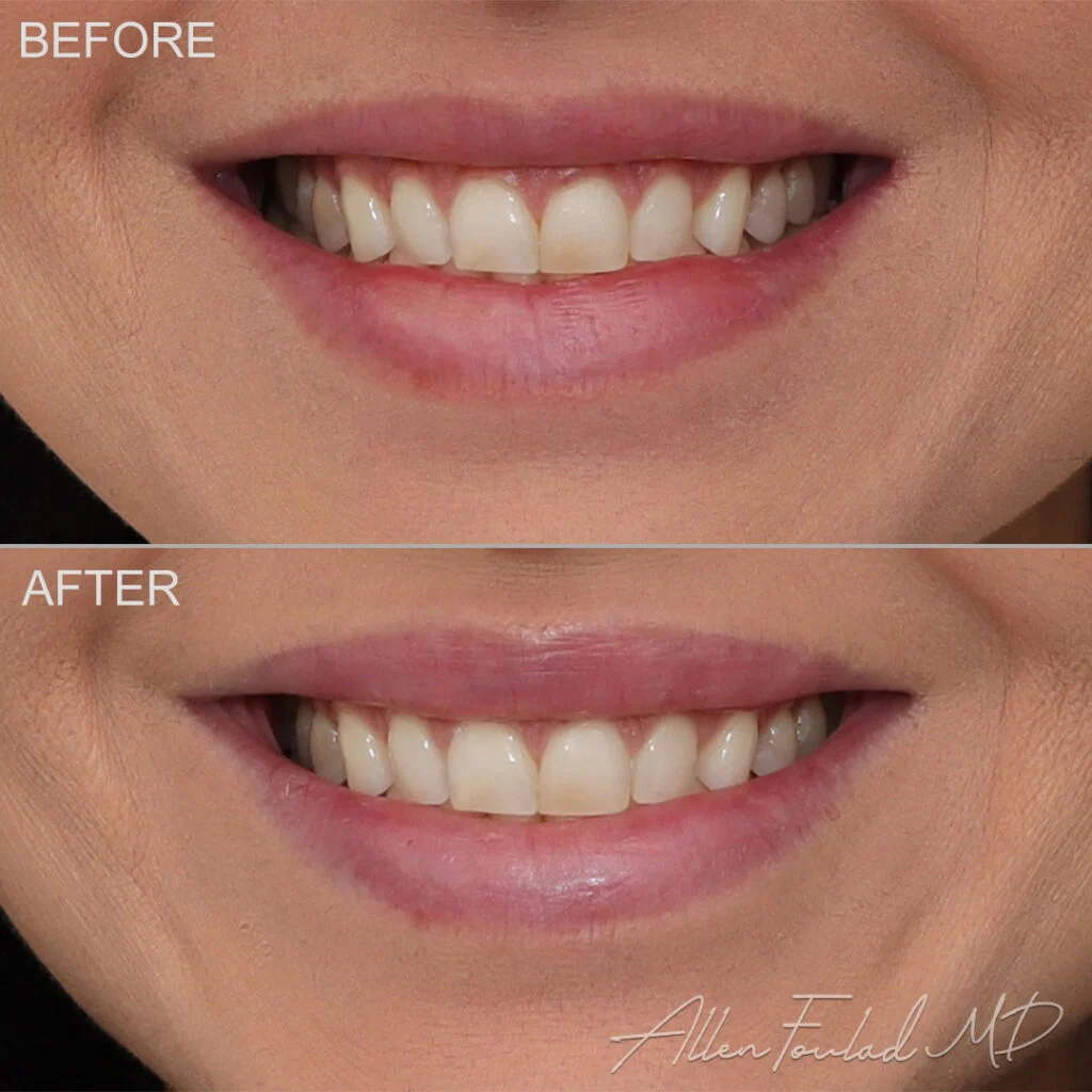 Botox Before and After Photo by Dr. Foulad in Beverly Hills California