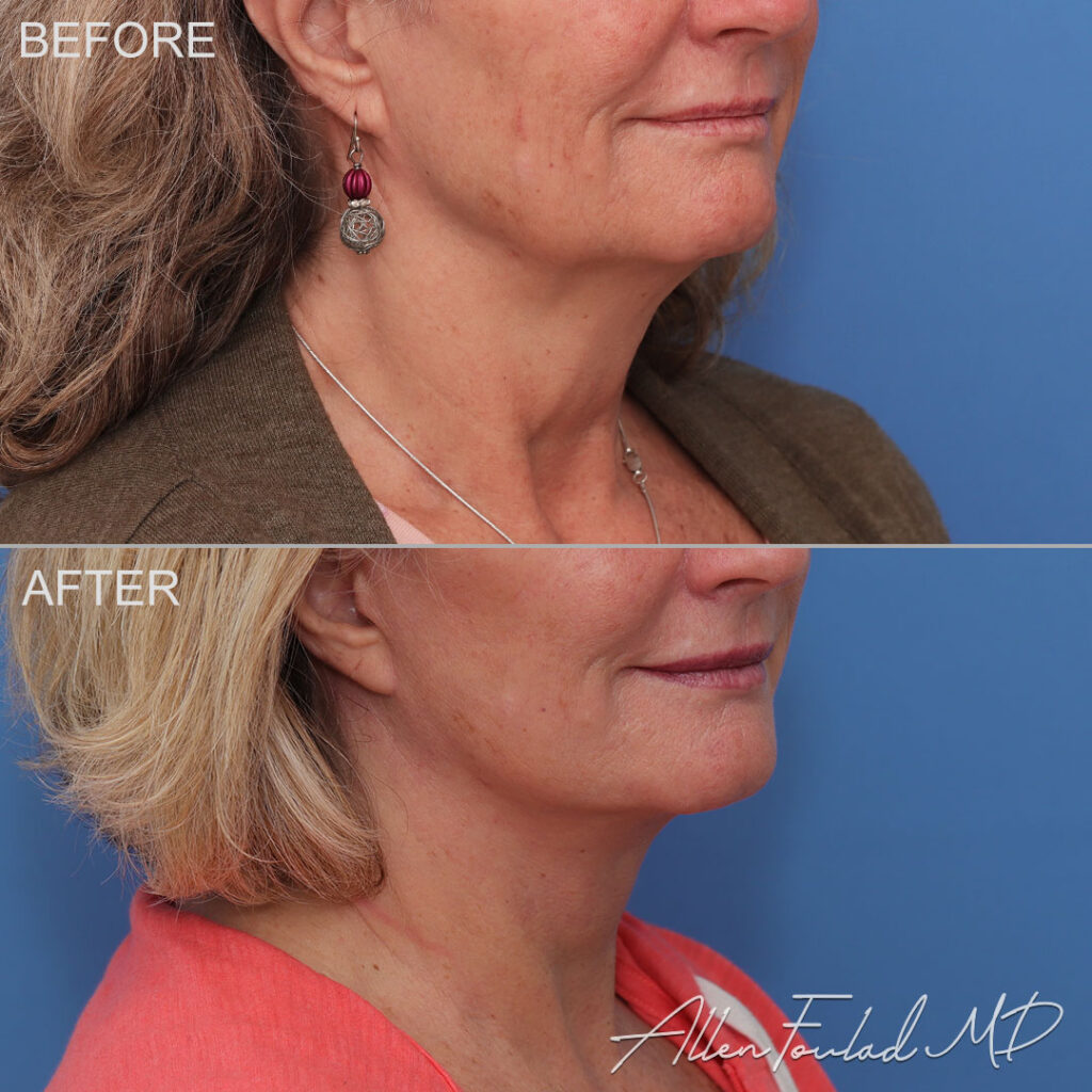 Facelift & Neck Lift Before and After Photo by Dr. Foulad in Beverly Hills California