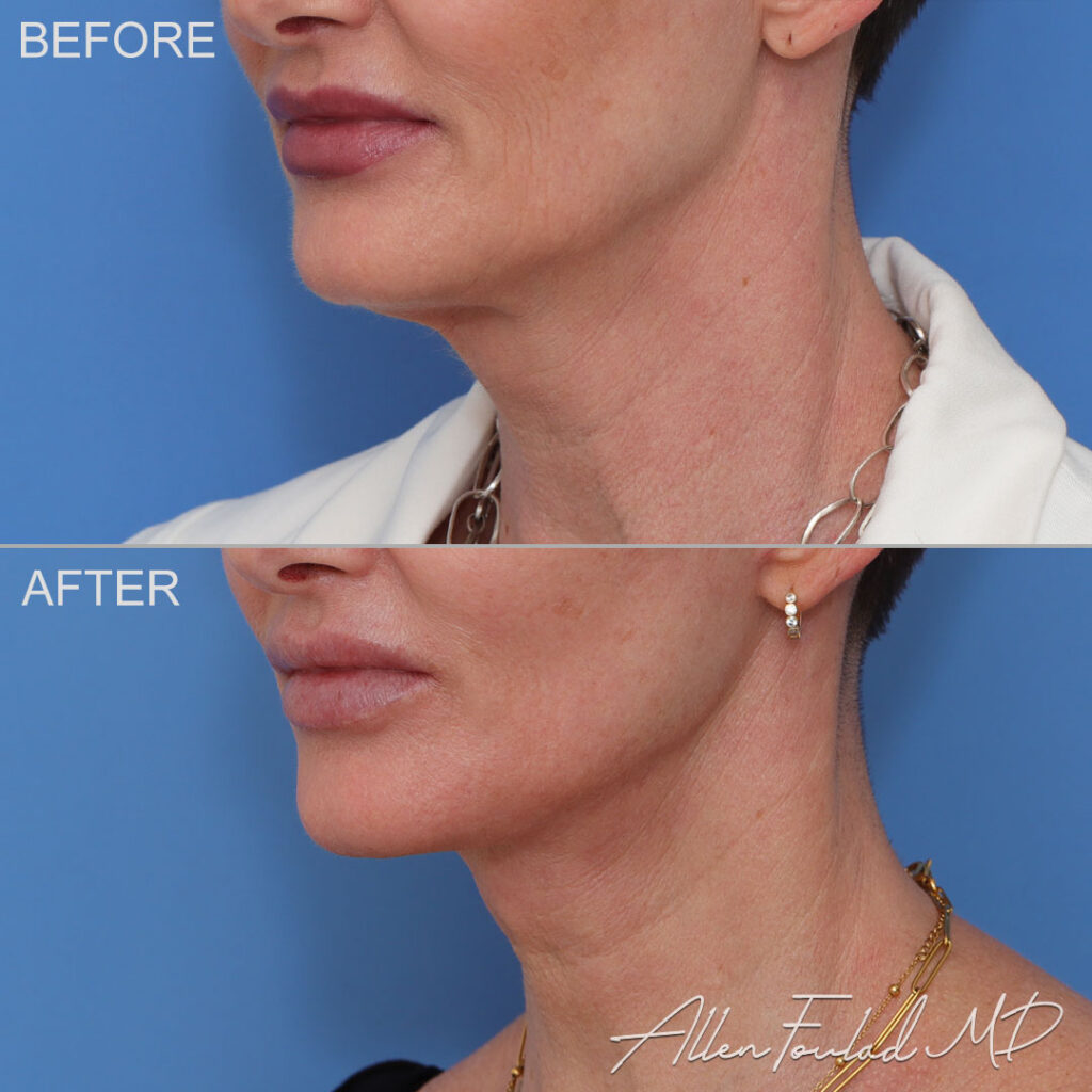 Facelift & Neck Lift Before and After Photo by Dr. Foulad in Beverly Hills California