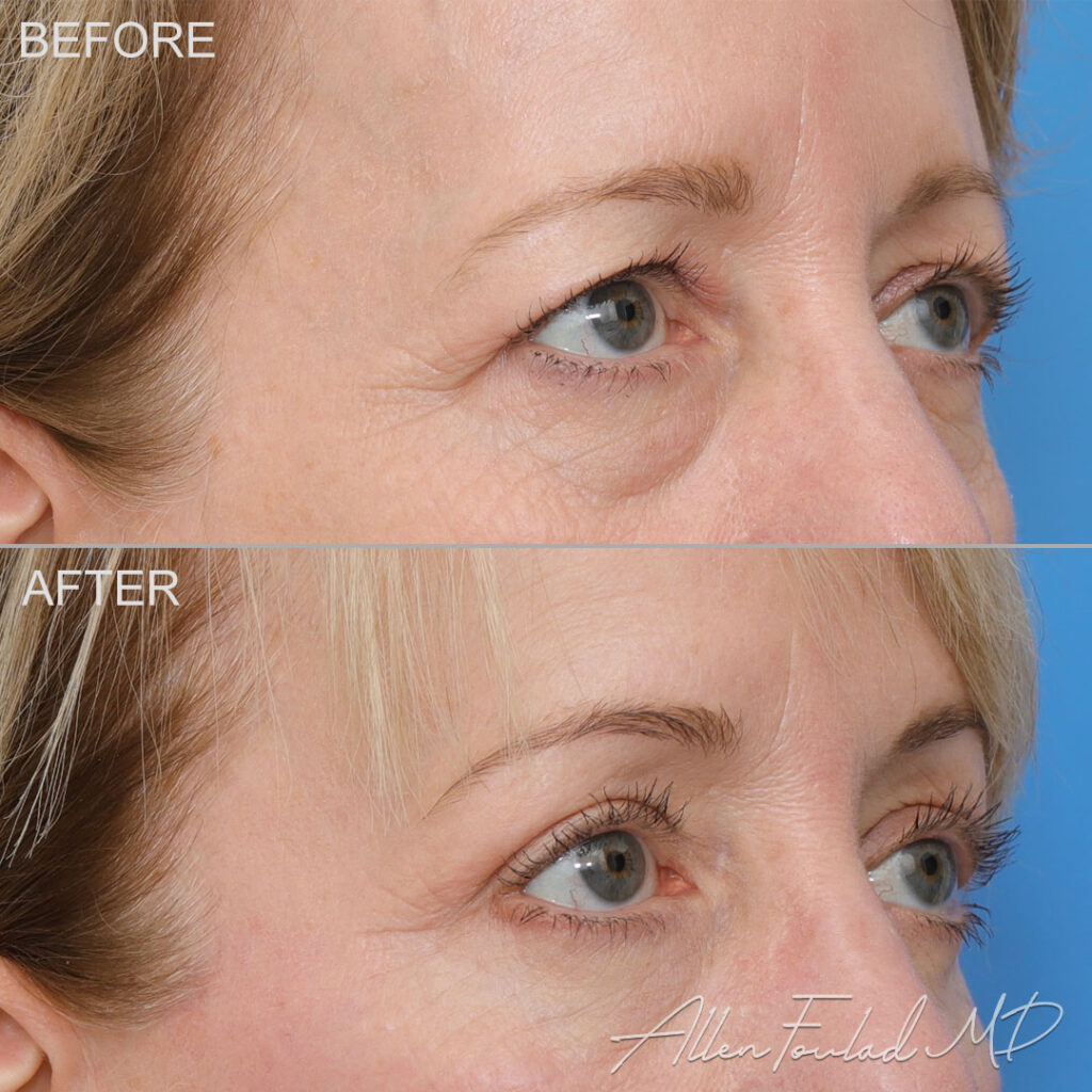 Lower Blepharoplasty Before and After Photo by Dr. Foulad in Beverly Hills California