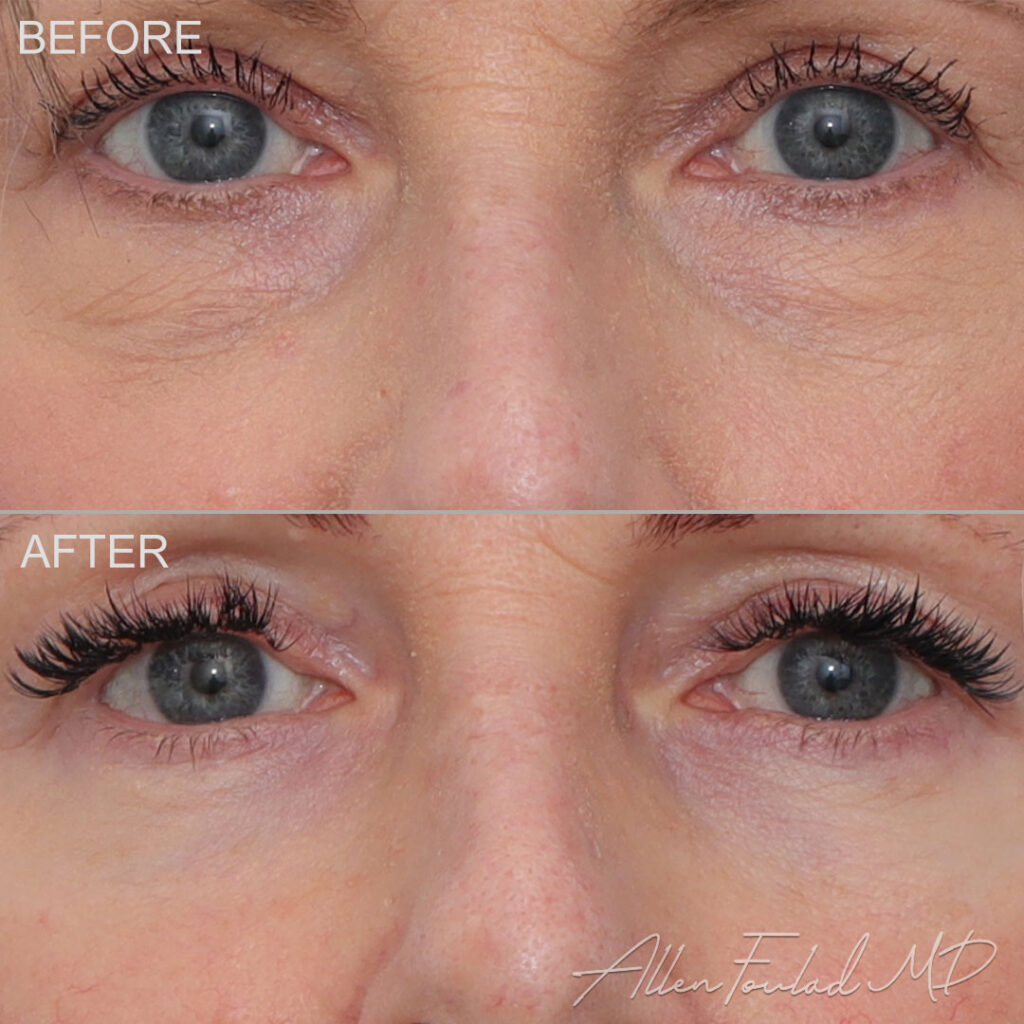 Lower Blepharoplasty Before and After Photo by Dr. Foulad in Beverly Hills California