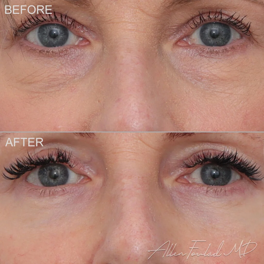 Lower Blepharoplasty Before and After Photo by Dr. Foulad in Beverly Hills California