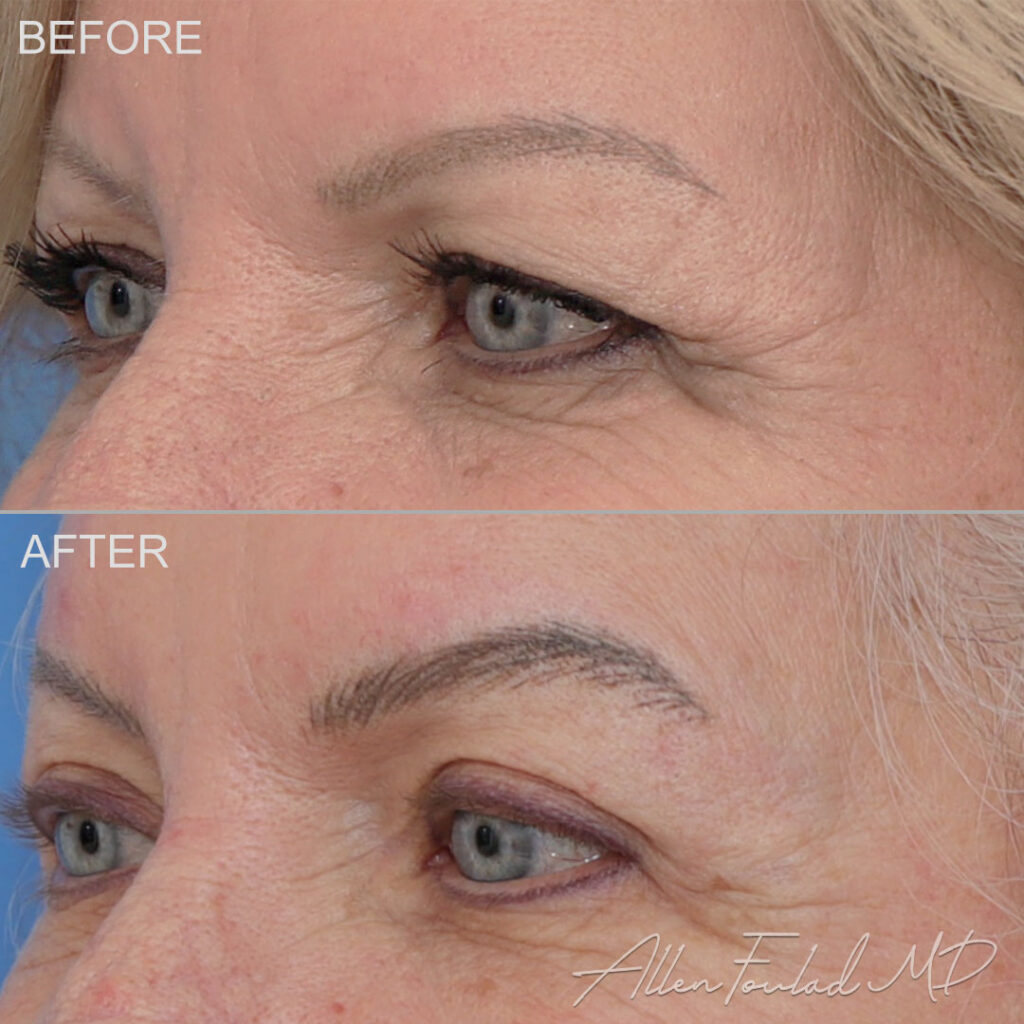 Upper Blepharoplasty Before and After Photo by Dr. Foulad in Beverly Hills California