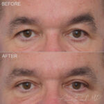 Upper Blepharoplasty Before and After Photo by Dr. Foulad in Beverly Hills California