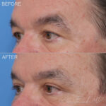 Upper Blepharoplasty Before and After Photo by Dr. Foulad in Beverly Hills California