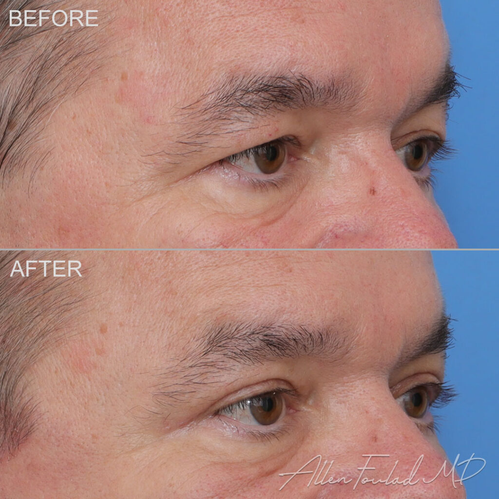 Upper Blepharoplasty Before and After Photo by Dr. Foulad in Beverly Hills California