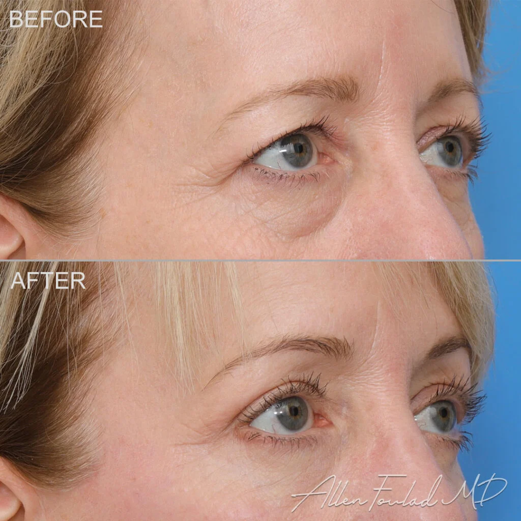 Lateral Temporal Brow Lift Before and After Photo by Dr. Foulad in Beverly Hills California