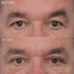 Lateral Temporal Brow Lift Before and After Photo by Dr. Foulad in Beverly Hills California