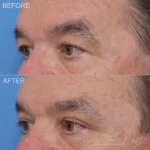 Lateral Temporal Brow Lift Before and After Photo by Dr. Foulad in Beverly Hills California