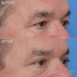 Lateral Temporal Brow Lift Before and After Photo by Dr. Foulad in Beverly Hills California