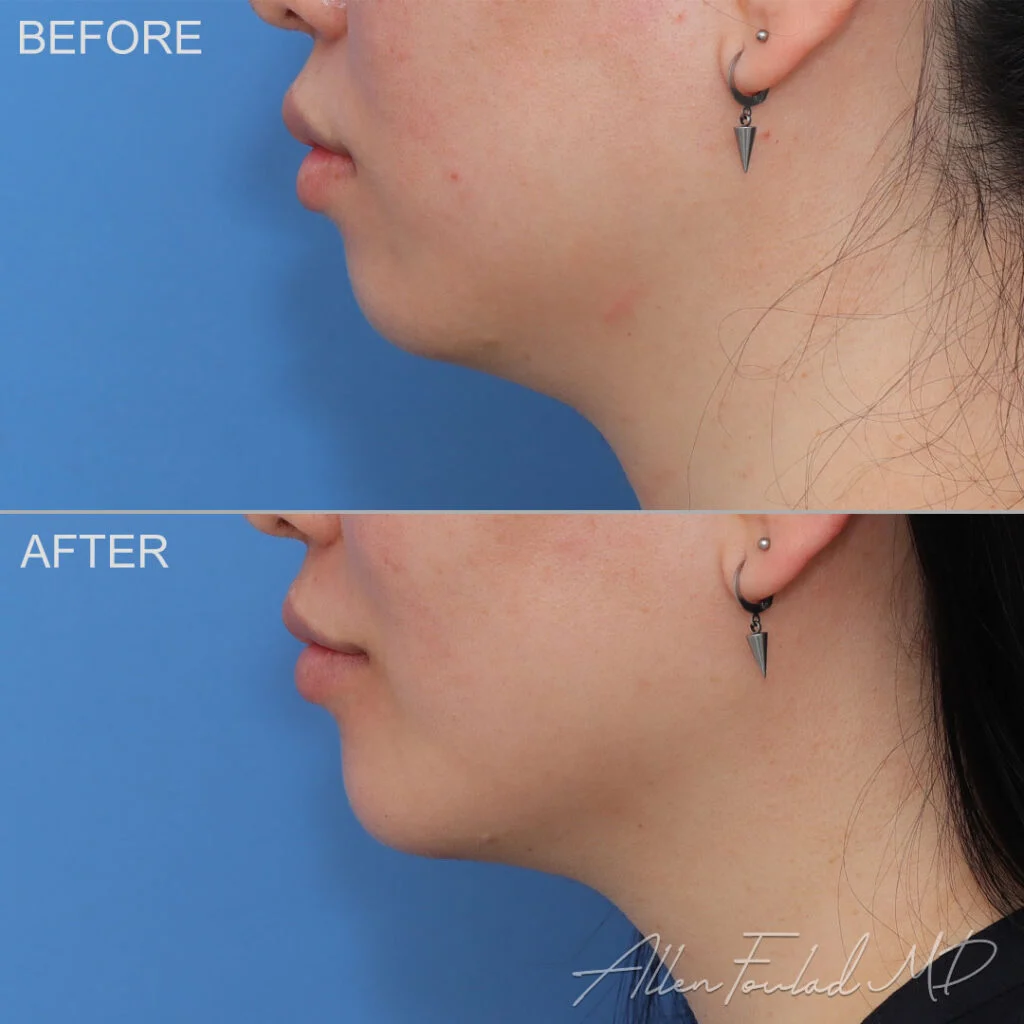 Chin Implant Before and After Photo by Dr. Foulad in Beverly Hills California