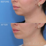 Chin Implant Before and After Photo by Dr. Foulad in Beverly Hills California