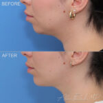 Chin Implant Before and After Photo by Dr. Foulad in Beverly Hills California