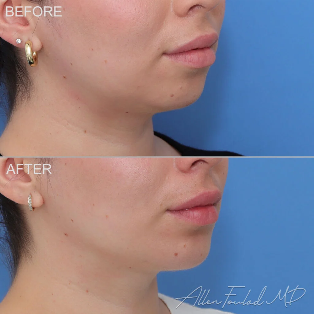 Chin Implant Before and After Photo by Dr. Foulad in Beverly Hills California