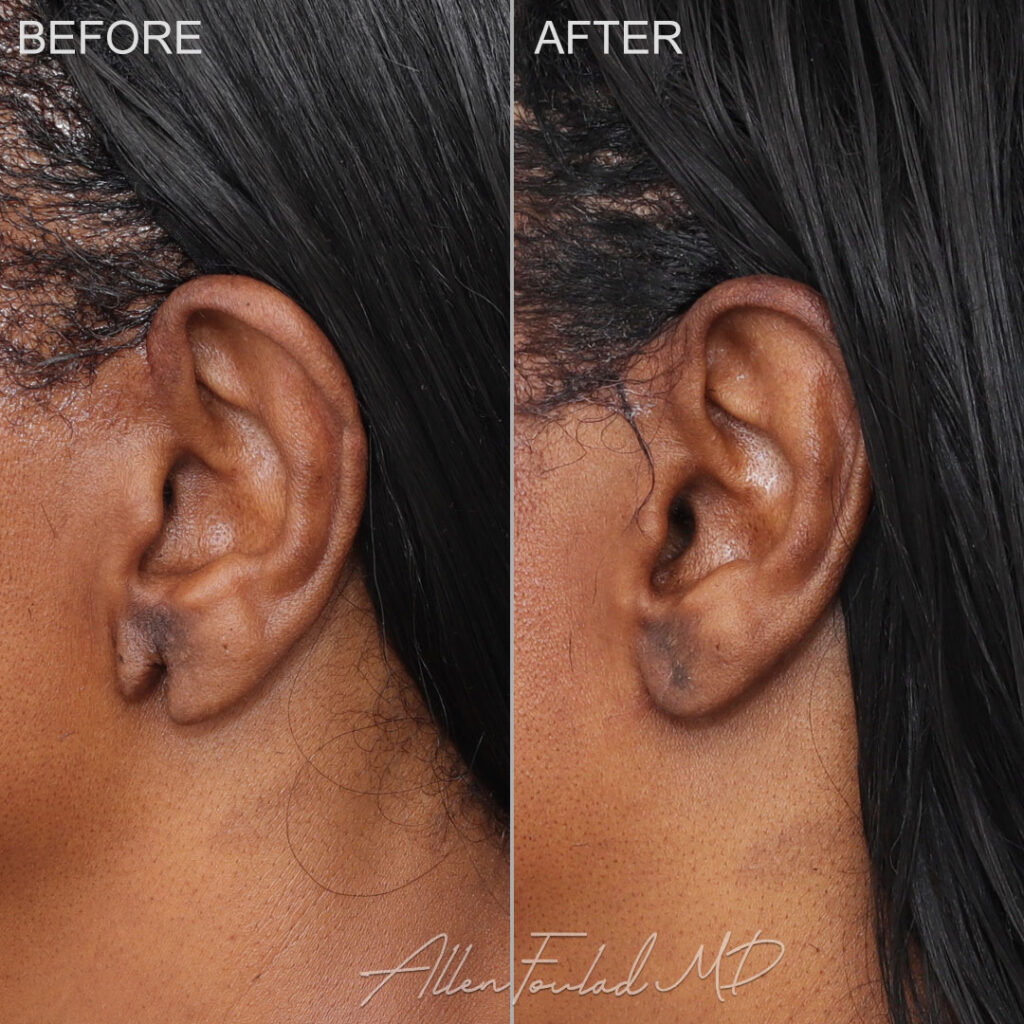 Earlobe Surgery Before and After Photo by Dr. Foulad in Beverly Hills California