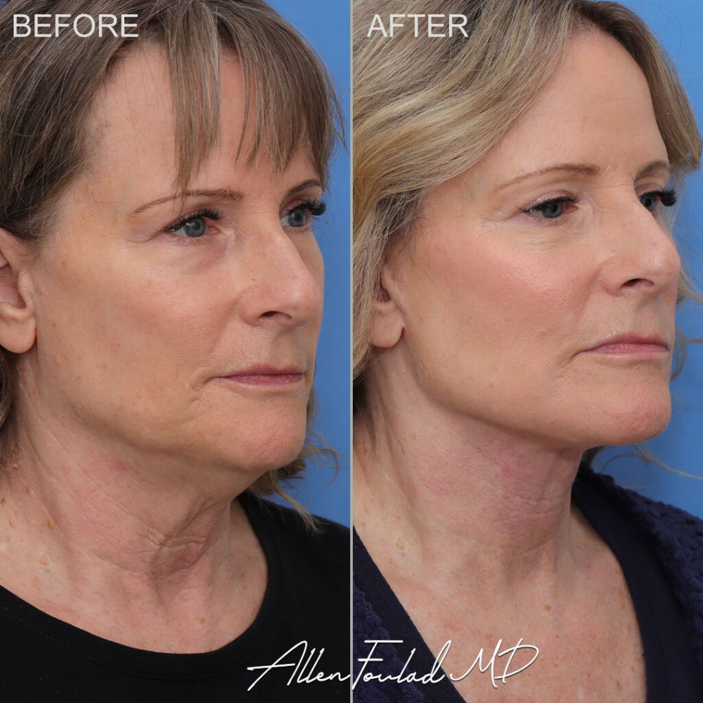 Facelift & Neck Lift Before and After Photo by Dr. Foulad in Beverly Hills California