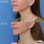 facelift-necklift-16-lo