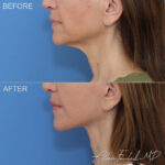 facelift-necklift-16-lp