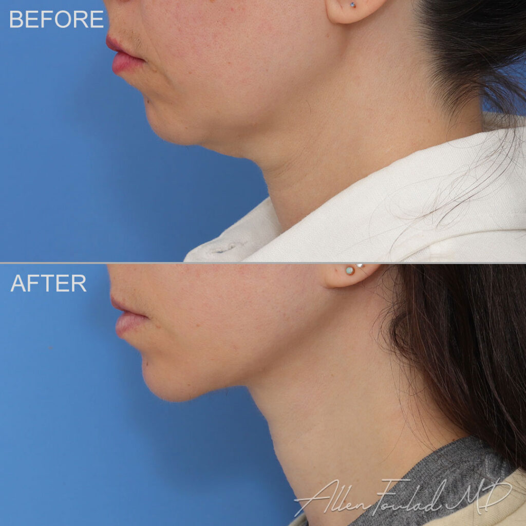 Facelift & Neck Lift Before and After Photo by Dr. Foulad in Beverly Hills California