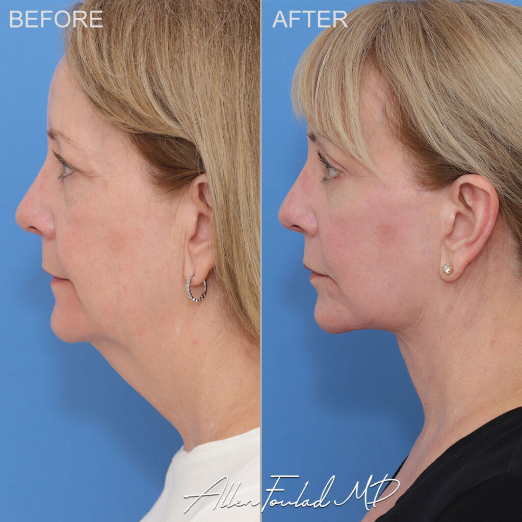 Facelift & Neck Lift Before and After Photo by Dr. Foulad in Beverly Hills California