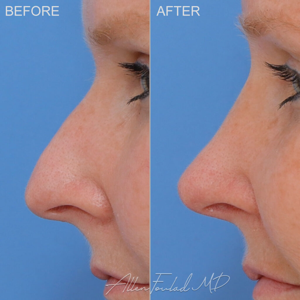 Rhinoplasty Before and After Photo by Dr. Foulad in Beverly Hills California