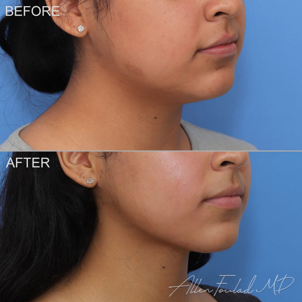 Before and after MIDS Neck Lift™, on female patient.