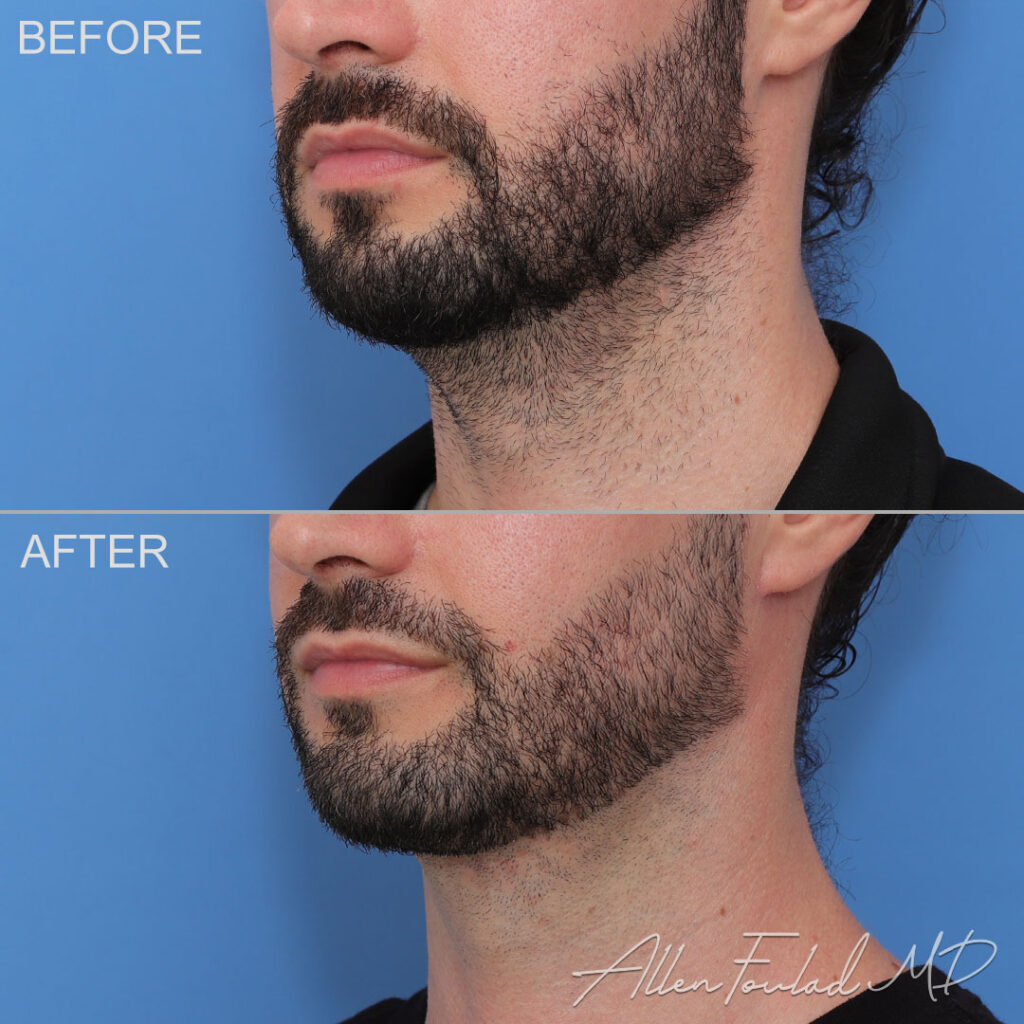 Before and after MIDS Neck Lift™, on male patient.