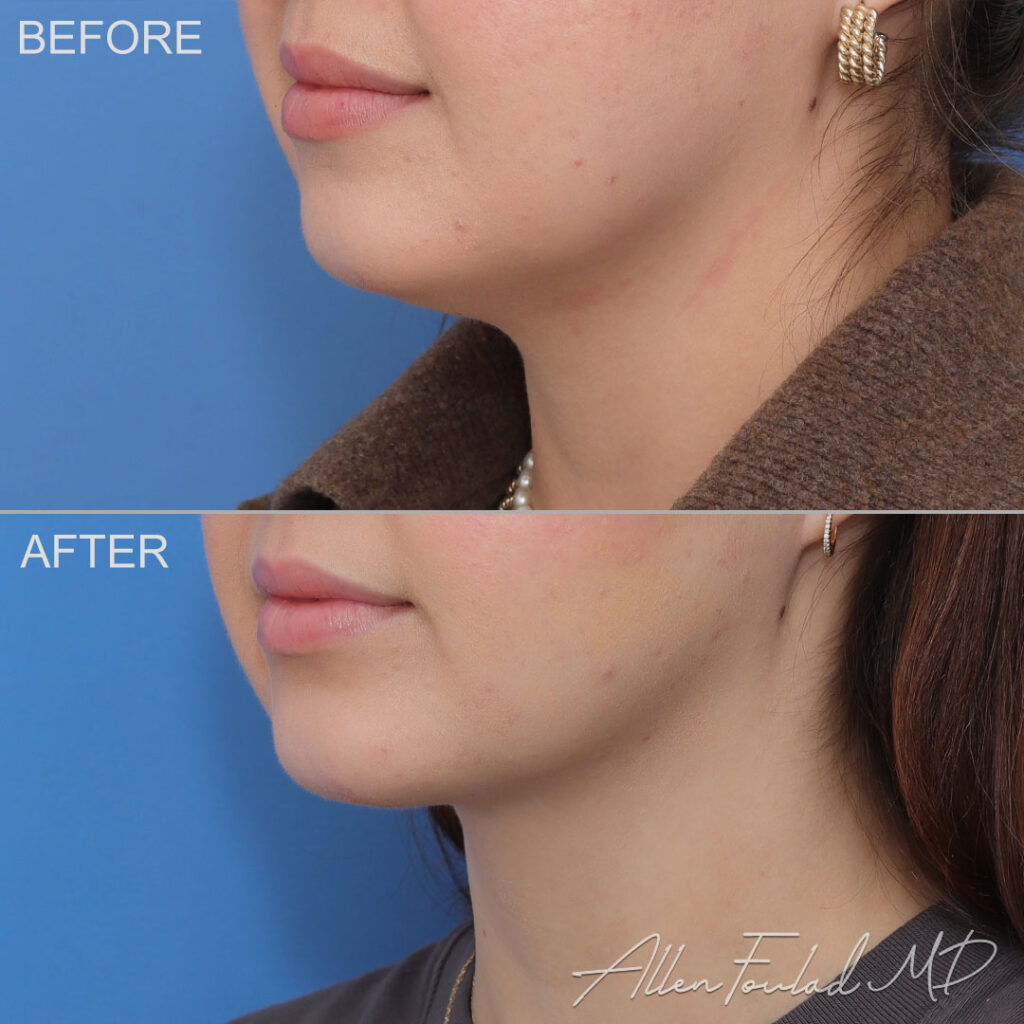 Before and after MIDS Neck Lift™, on female patient.